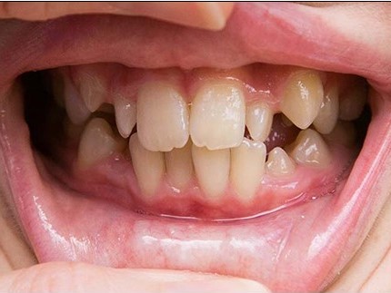 Crooked Teeth