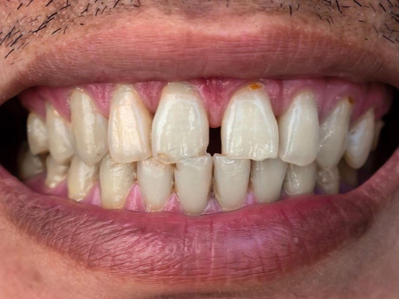 Gapped Teeth