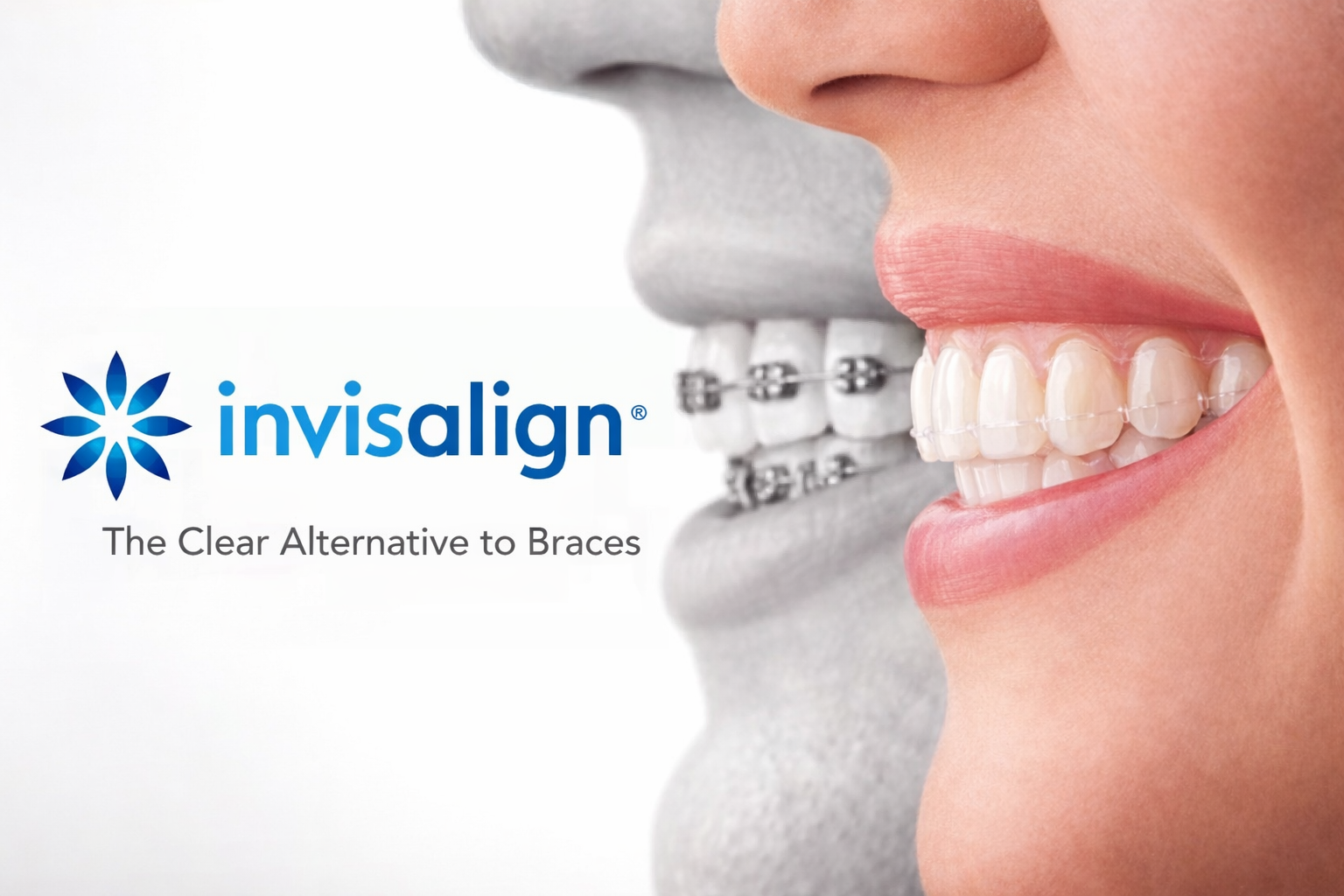 USA Invisalign